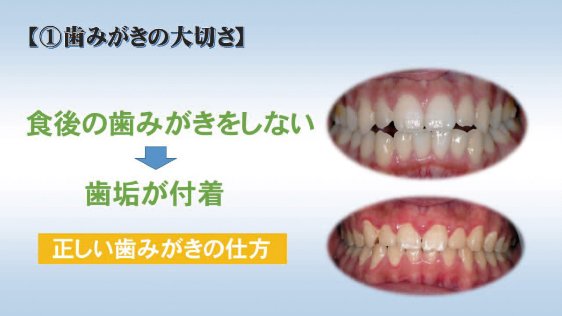 歯科指導教材パワーポイント歯を大切に ブラッシング基礎の基礎 中学・高校編vol.1